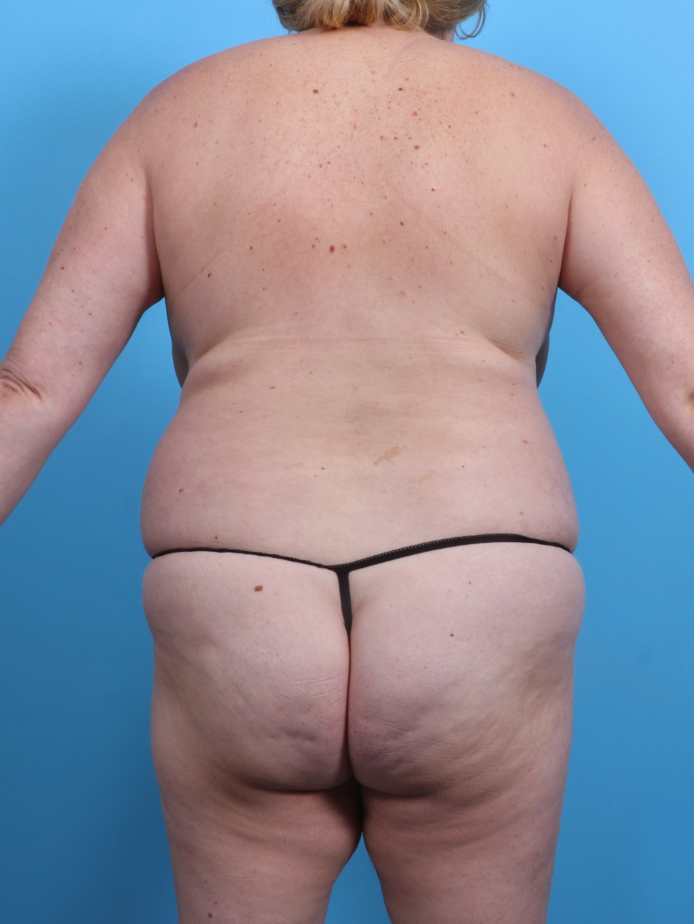 Liposuction Patient Photo - Case 3991 - before view-1