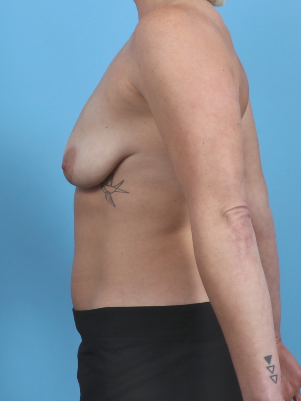 Breast Lift with Implants Patient Photo - Case 4027 - before view-2