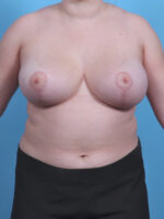 Breast Lift/Reduction - Case 4057 - After