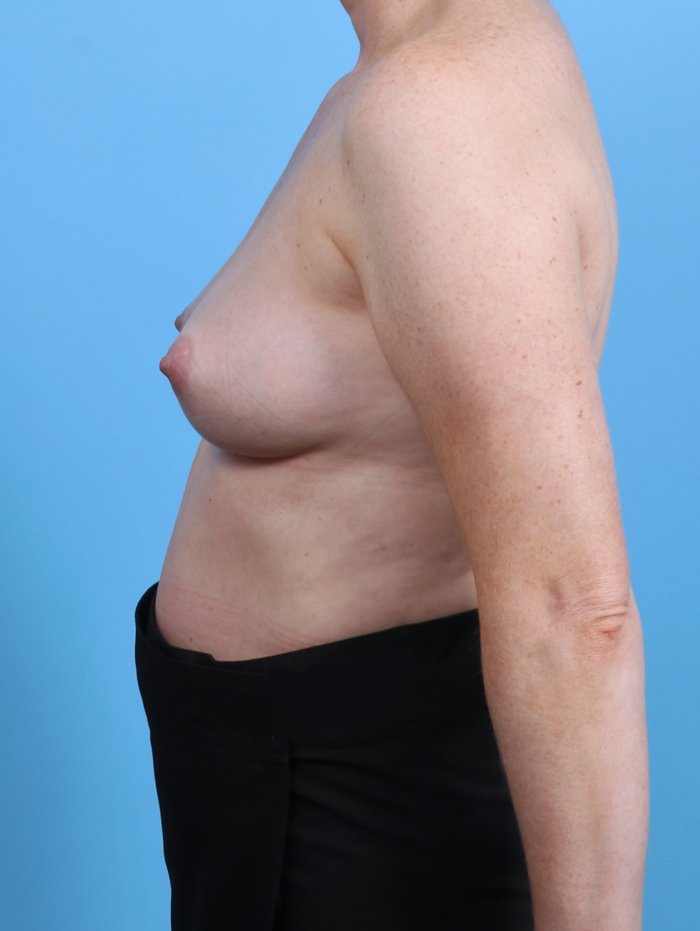 Breast Augmentation Patient Photo - Case 4091 - before view-2