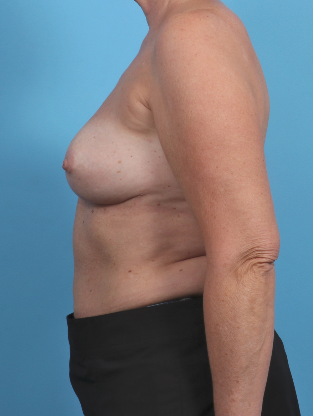 Breast Implant Revision Patient Photo - Case 4107 - after view-2