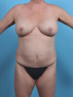 Breast Implant Revision - Case 4131 - Before