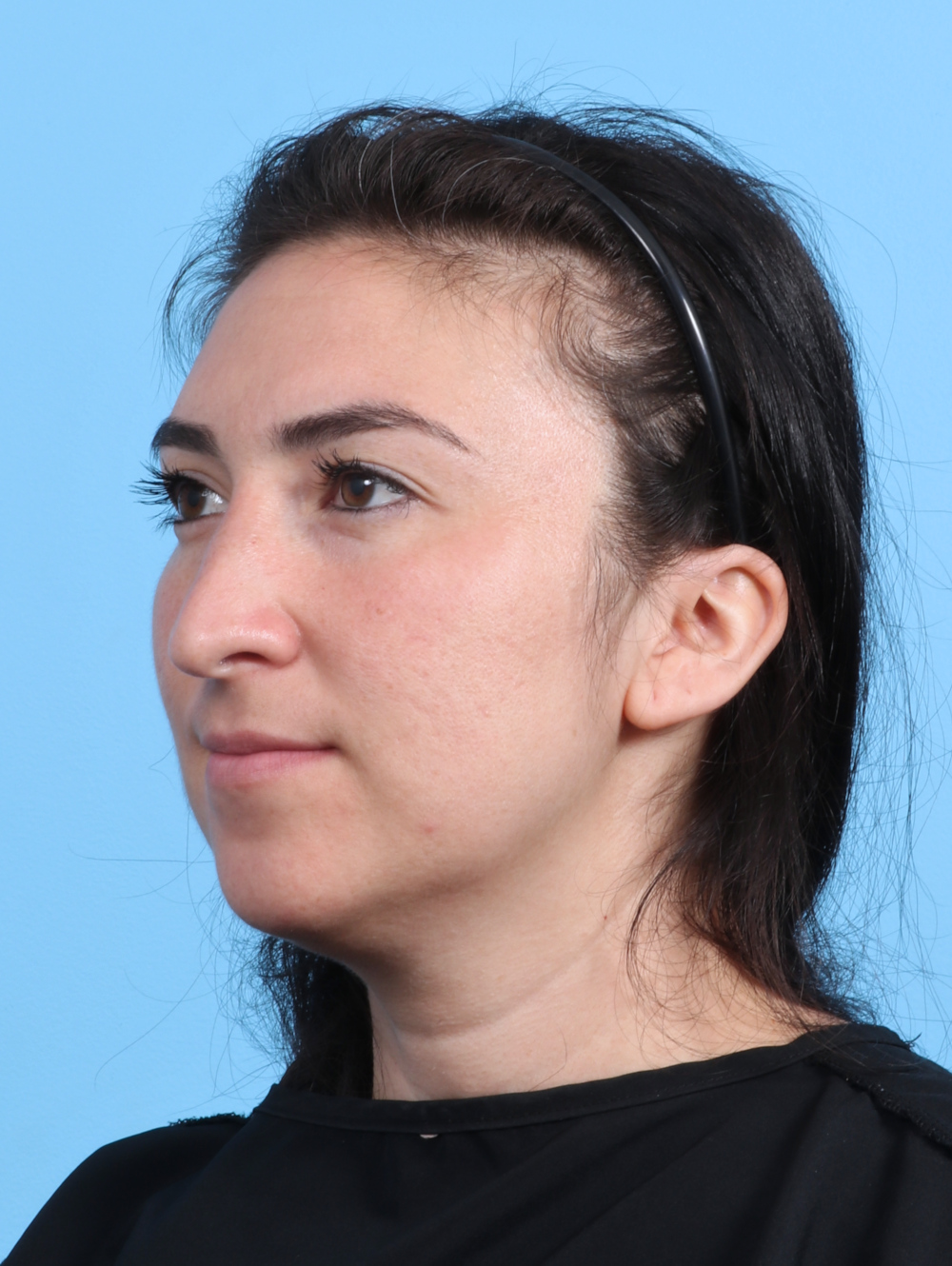 Rhinoplasty Patient Photo - Case 4155 - before view-2