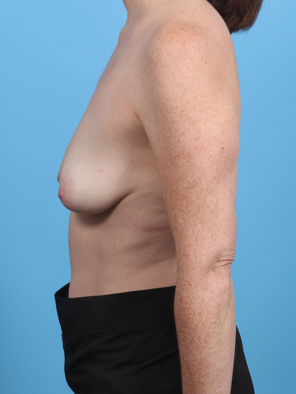 Breast Lift/Reduction Patient Photo - Case 4171 - before view-2