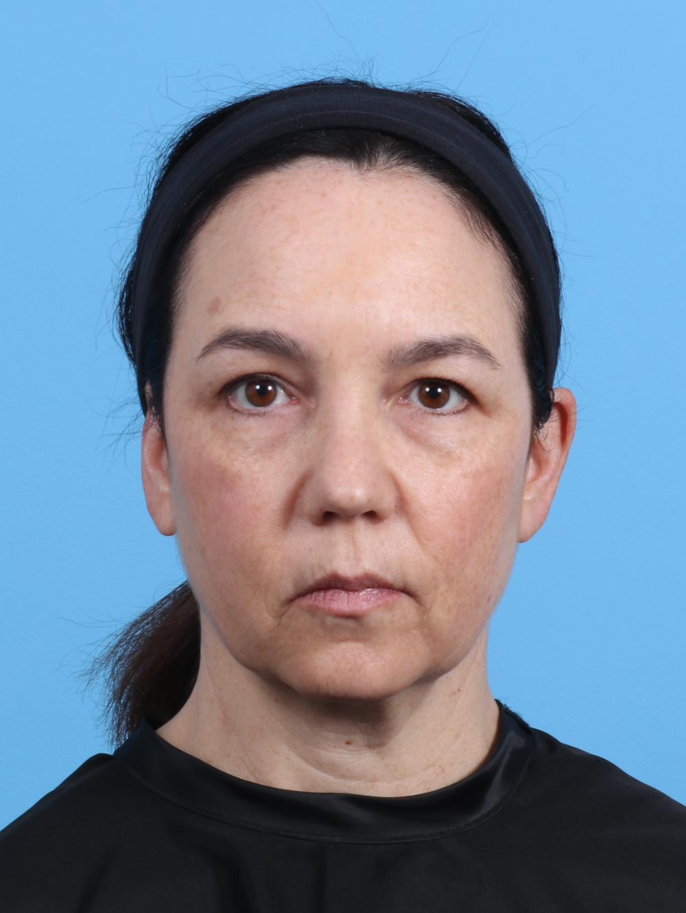Eyelid Surgery Patient Photo - Case 4179 - before view-