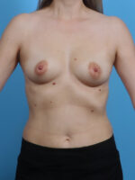 Breast Augmentation - Case 4203 - Before