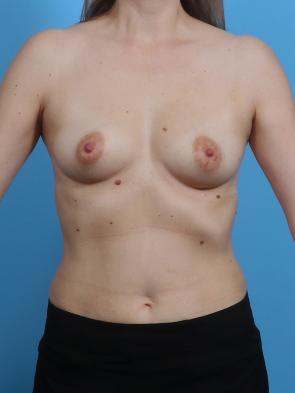 Breast Augmentation Patient Photo - Case 4203 - before view-