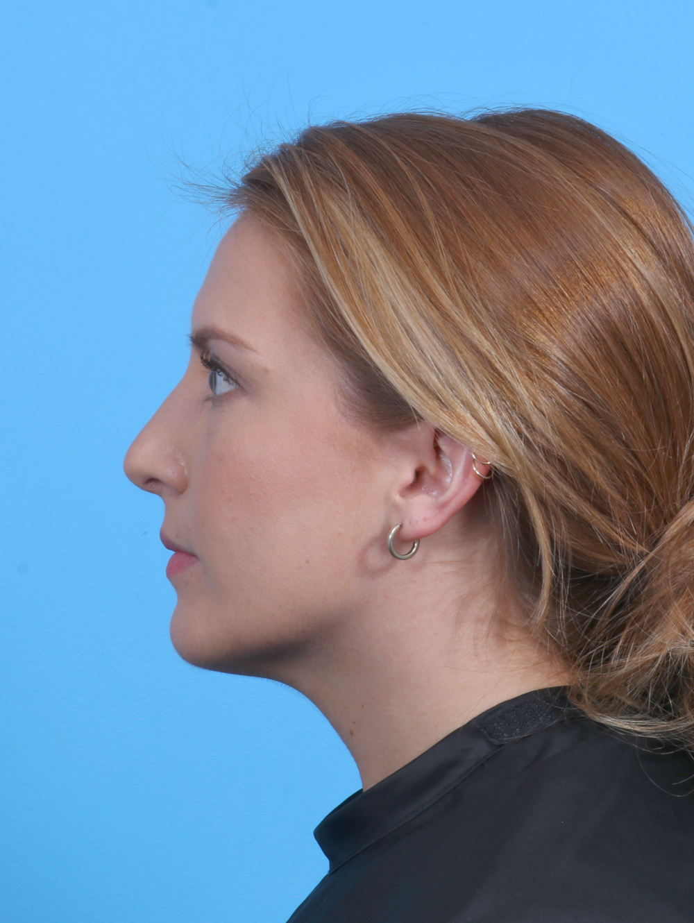 Rhinoplasty Patient Photo - Case 4229 - after view
