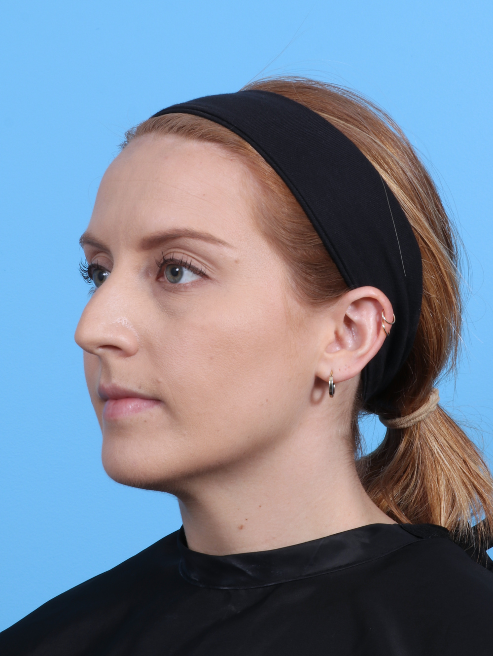 Rhinoplasty Patient Photo - Case 4229 - before view-2