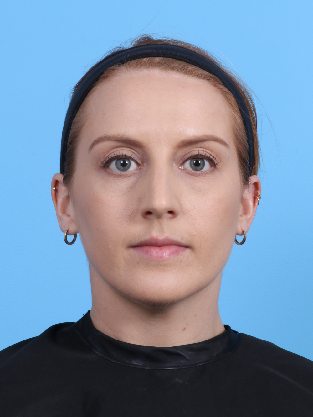 Rhinoplasty Patient Photo - Case 4229 - before view-1