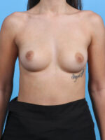 Breast Augmentation - Case 4273 - Before