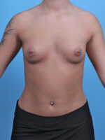 Breast Augmentation - Case 4313 - Before