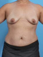 Breast Lift with Implants - Case 4347 - Before