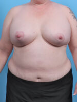 Breast Lift with Implants - Case 4363 - After