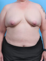 Breast Lift with Implants - Case 4363 - Before