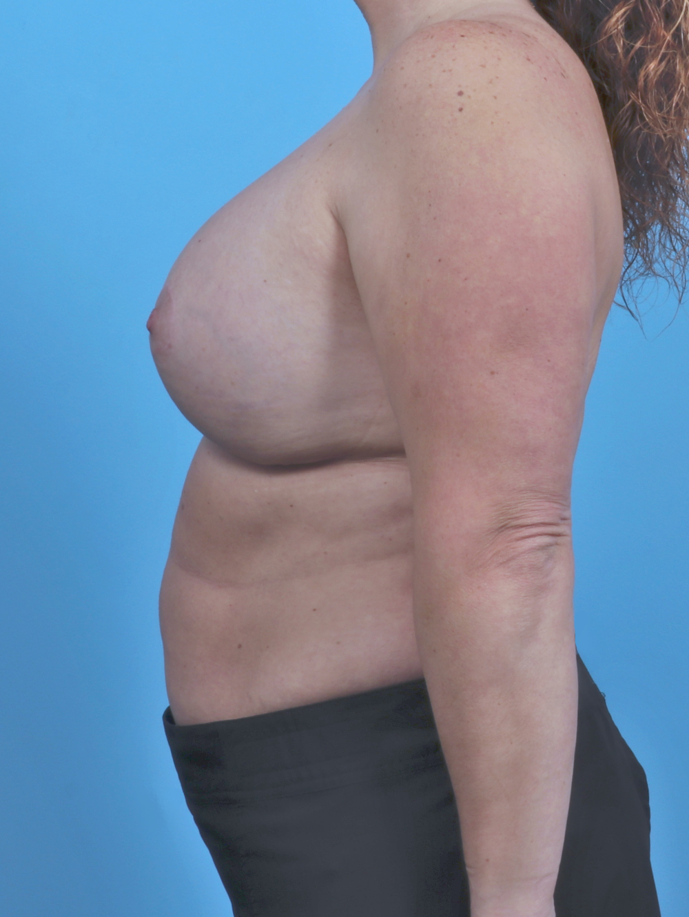 Breast Lift/Reduction Patient Photo - Case 4395 - after view-2