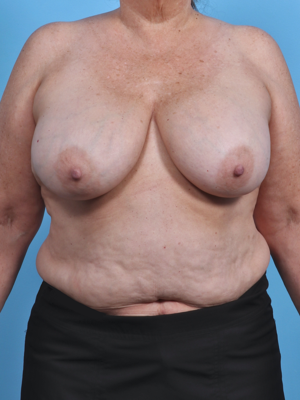 Breast Implant Revision Patient Photo - Case 4403 - before view-