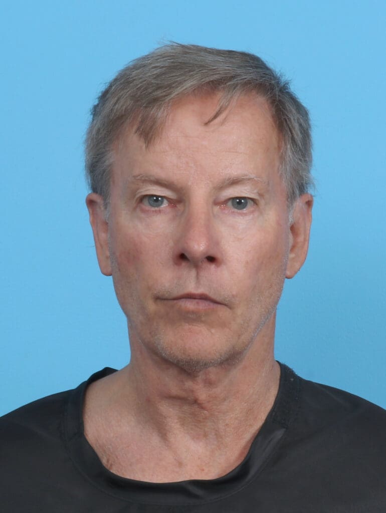 Ear Surgery - Case 4432 - After