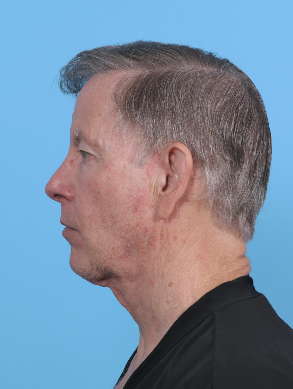 Ear Surgery Patient Photo - Case 4432 - before view-2