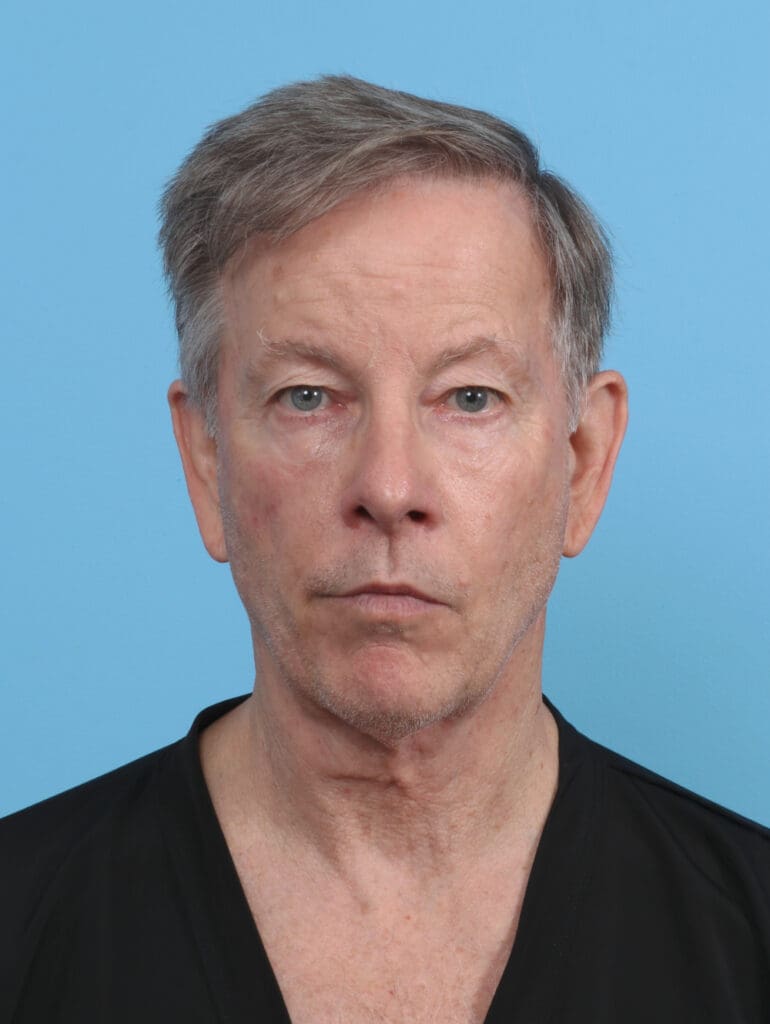 Ear Surgery - Case 4432 - Before