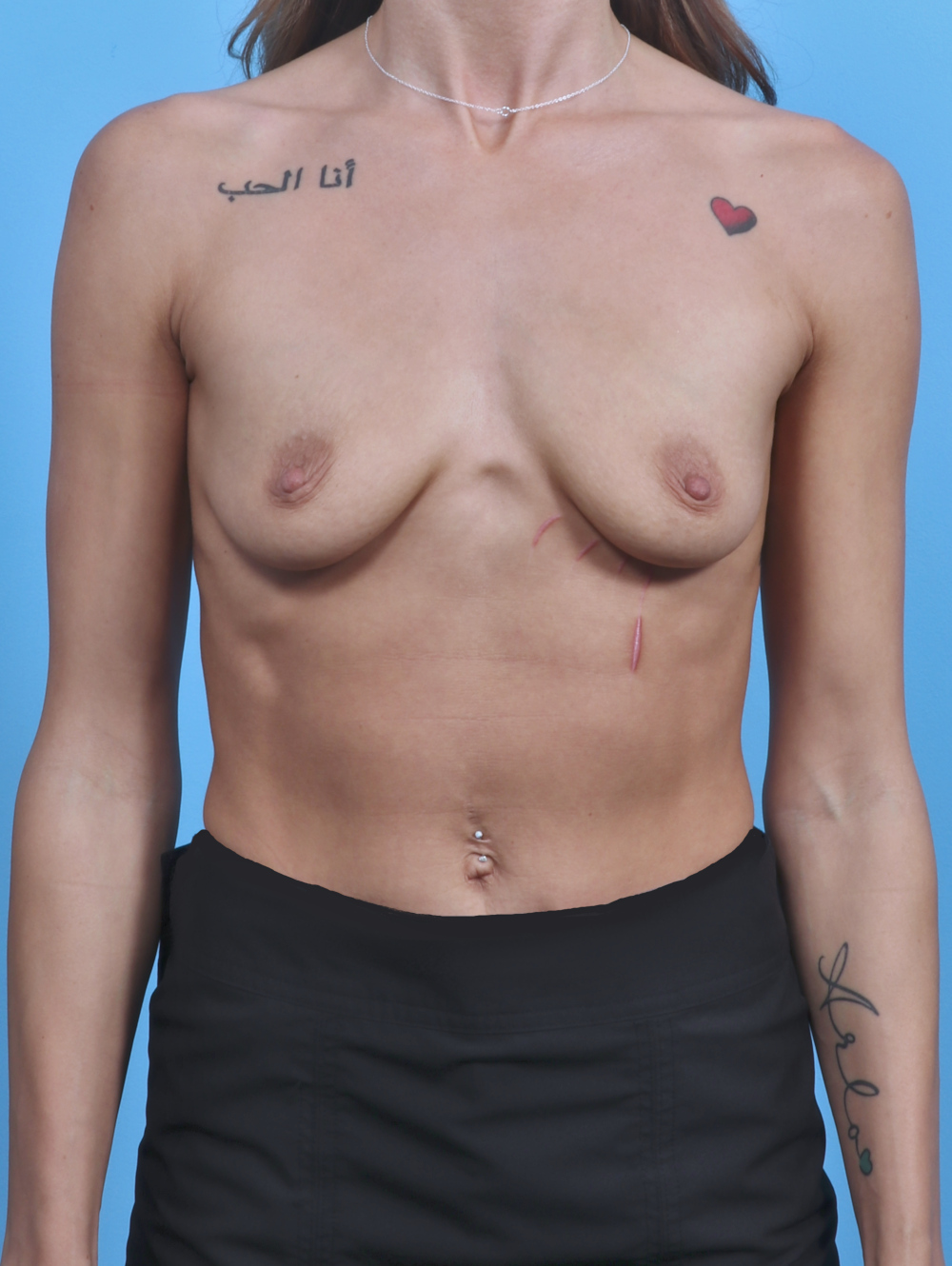 Breast Augmentation Patient Photo - Case 4455 - before view-0
