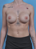 Breast Augmentation - Case 4455 - After