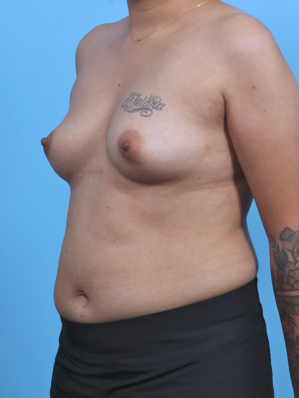 Breast Augmentation Patient Photo - Case 4463 - before view-1