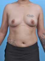 Breast Augmentation - Case 4463 - Before