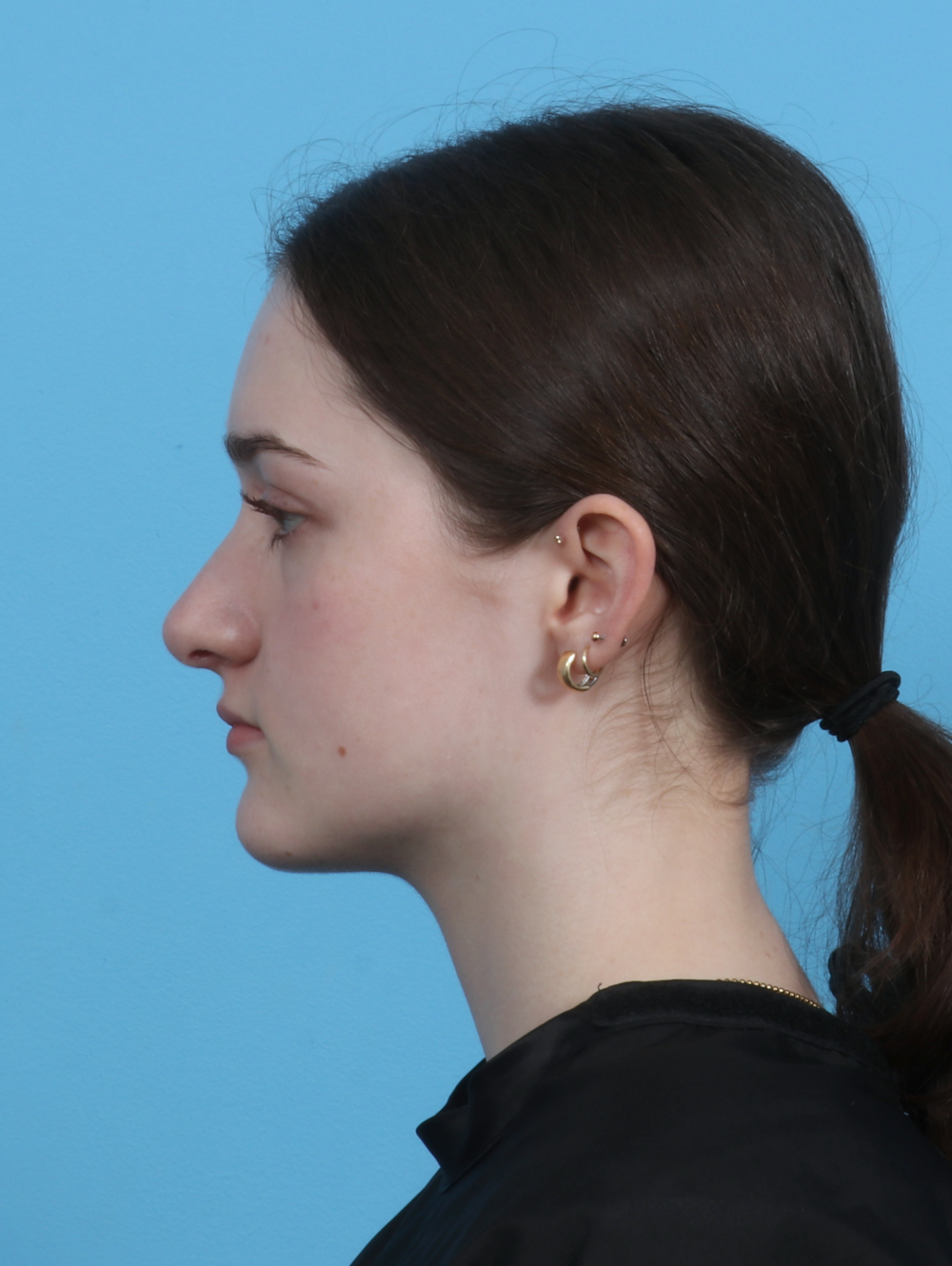 Rhinoplasty Patient Photo - Case 4481 - after view-0
