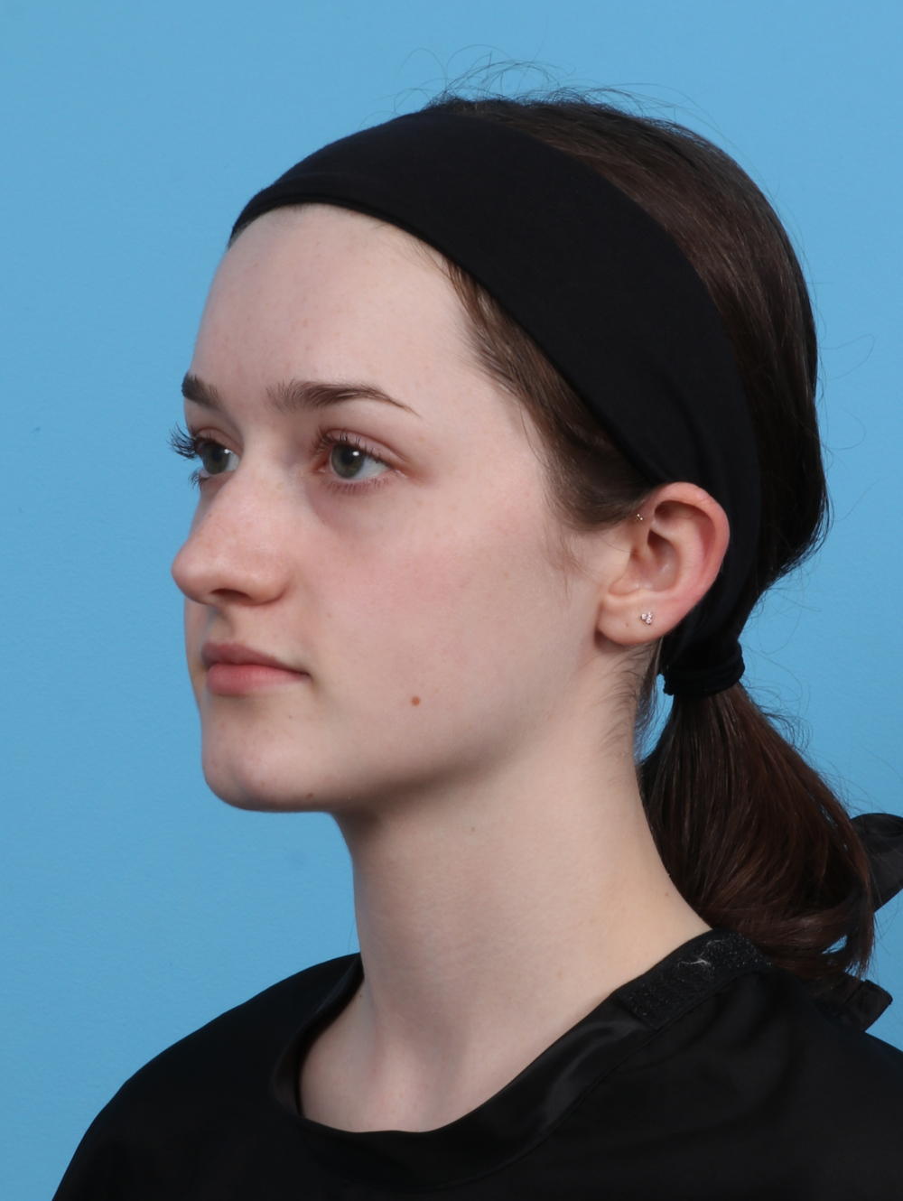 Rhinoplasty Patient Photo - Case 4481 - before view-2