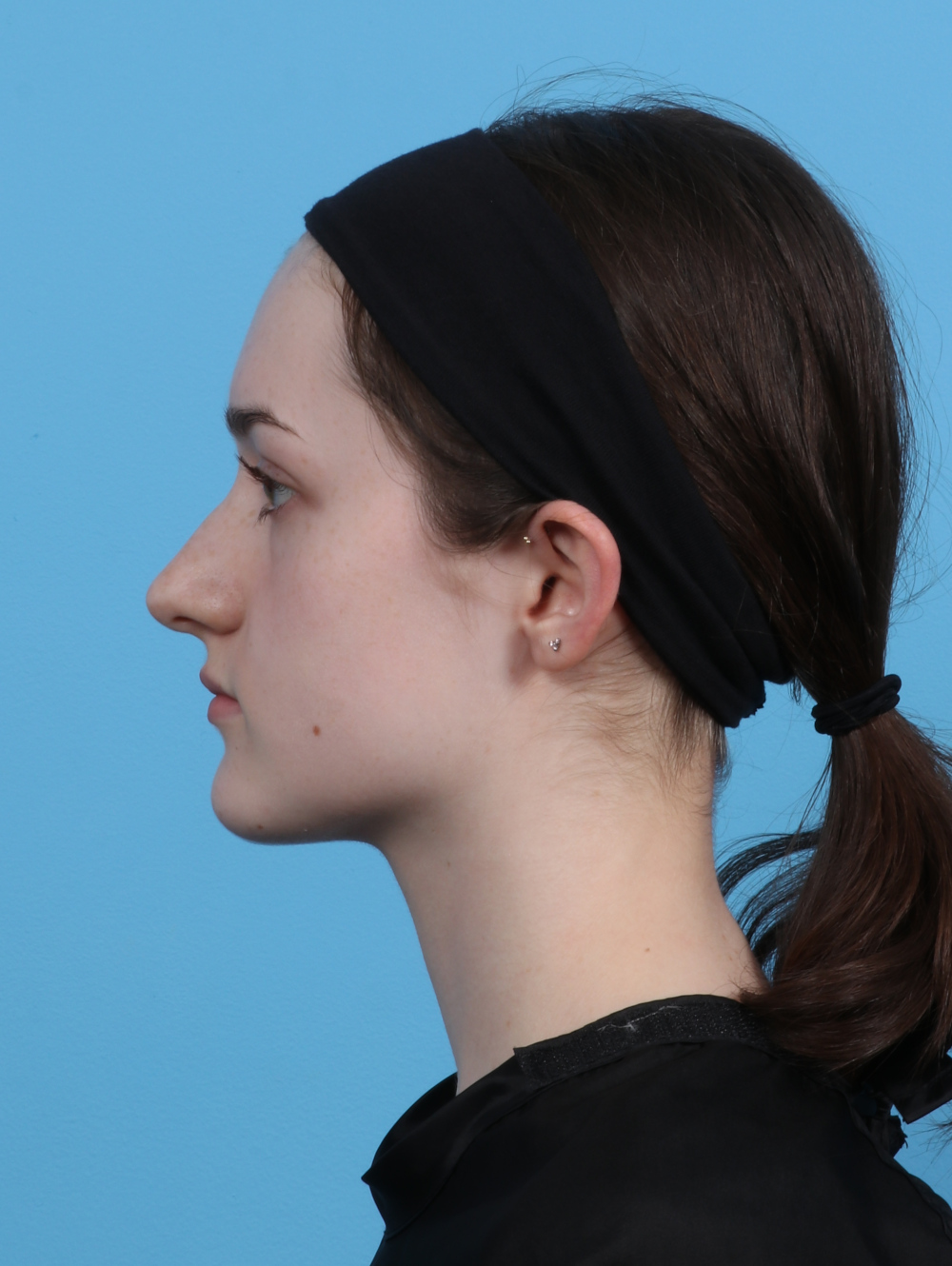 Rhinoplasty Patient Photo - Case 4481 - before view-