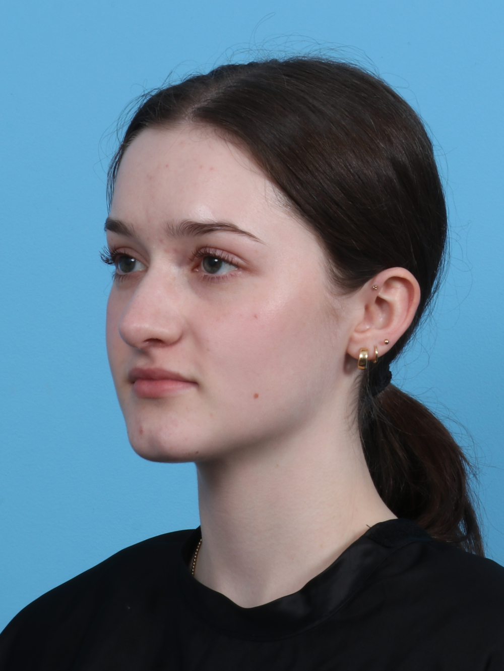 Rhinoplasty Patient Photo - Case 4481 - after view-2