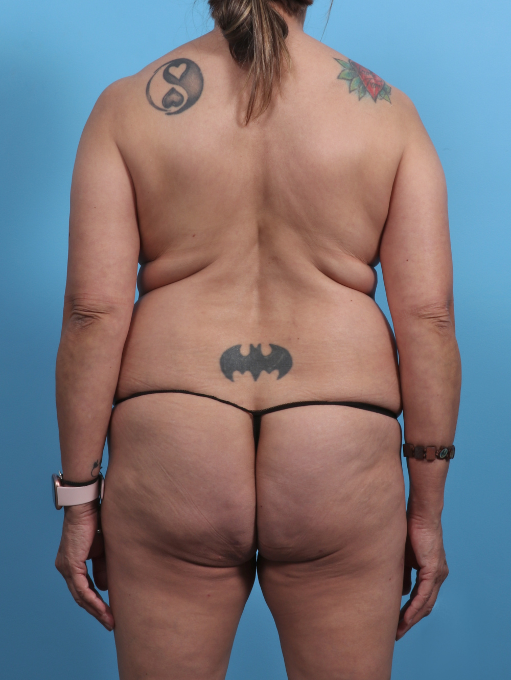 Liposuction Patient Photo - Case 4489 - before view-1