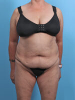 Liposuction - Case 4489 - Before