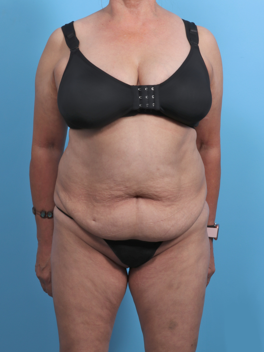 Liposuction Patient Photo - Case 4489 - before view-0