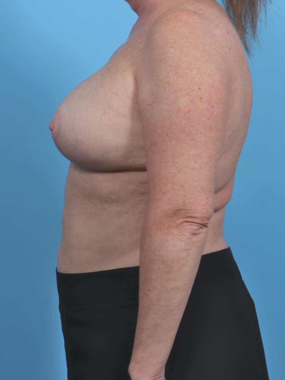 Breast Implant Revision Patient Photo - Case 4507 - after view-2
