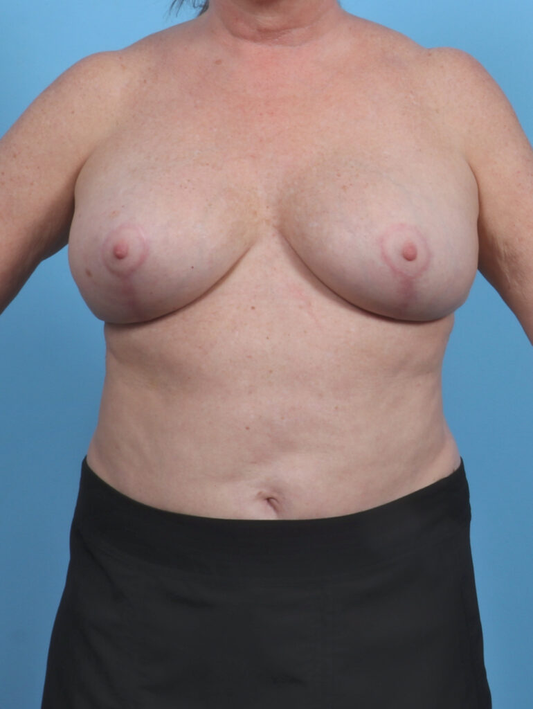 Breast Implant Revision - Case 4507 - After
