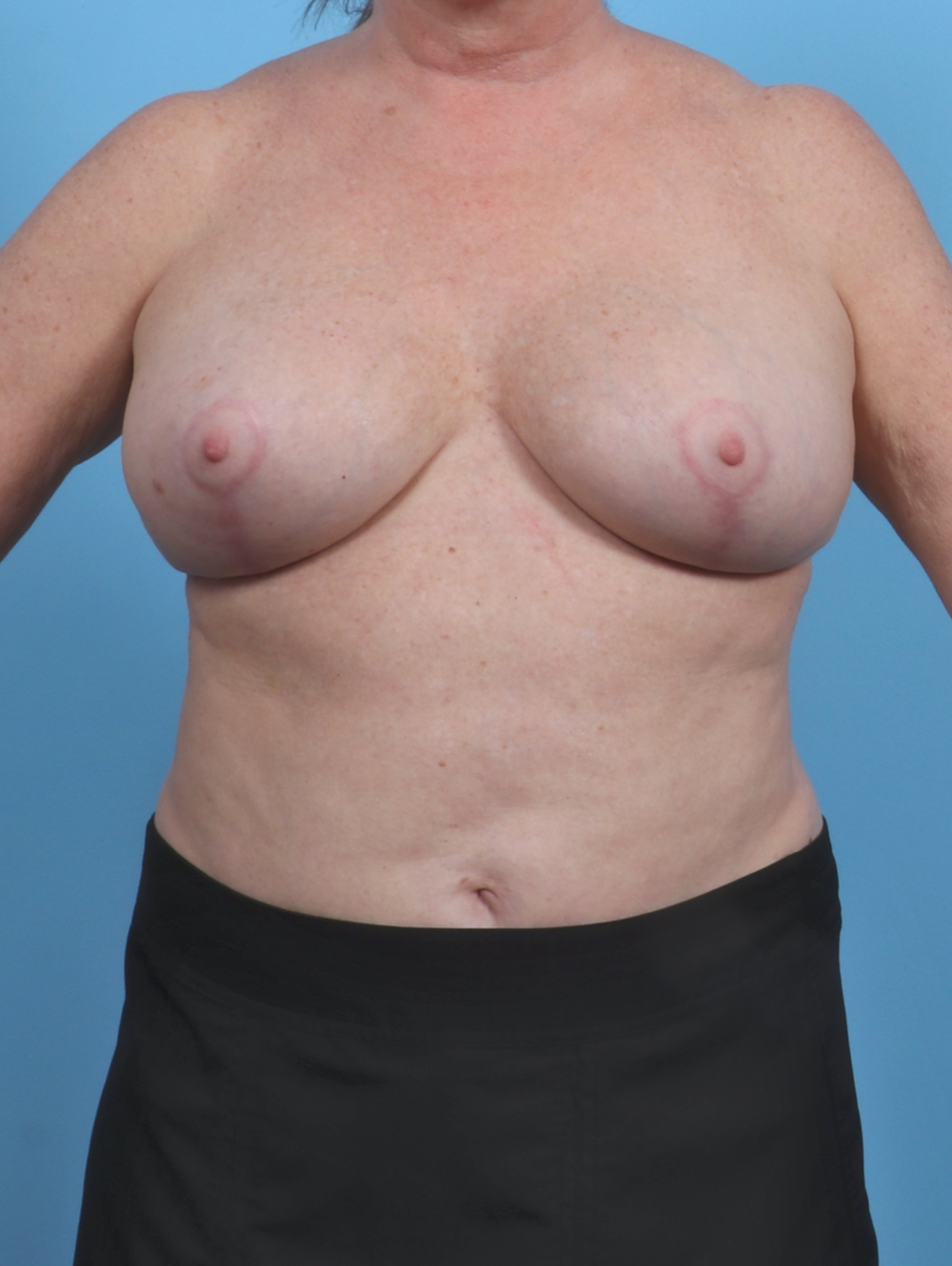 Breast Implant Revision Patient Photo - Case 4507 - after view