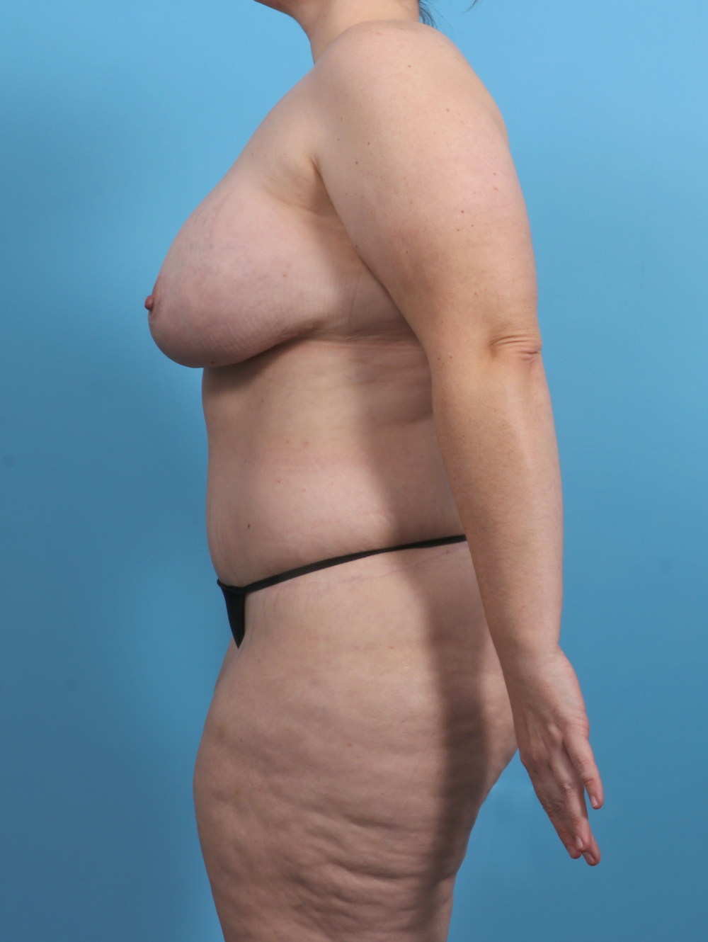 Breast Lift with Implants Patient Photo - Case 4533 - after view-3