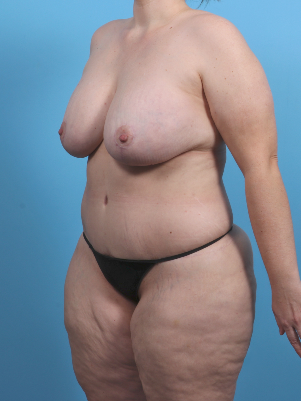 Breast Lift with Implants Patient Photo - Case 4533 - after view-1