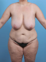Breast Lift with Implants - Case 4533 - Before