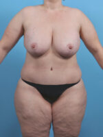 Breast Lift with Implants - Case 4533 - After