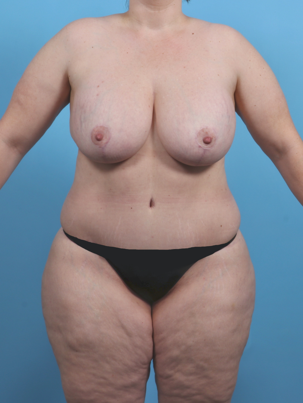Breast Lift with Implants Patient Photo - Case 4533 - after view