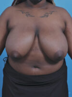 Breast Lift/Reduction - Case 4561 - Before