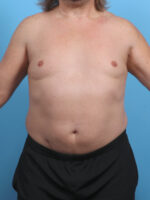 Liposuction - Case 4569 - After