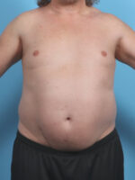 Liposuction - Case 4569 - Before