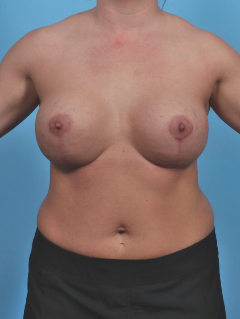Breast Implant Revision - Case 4826 - After