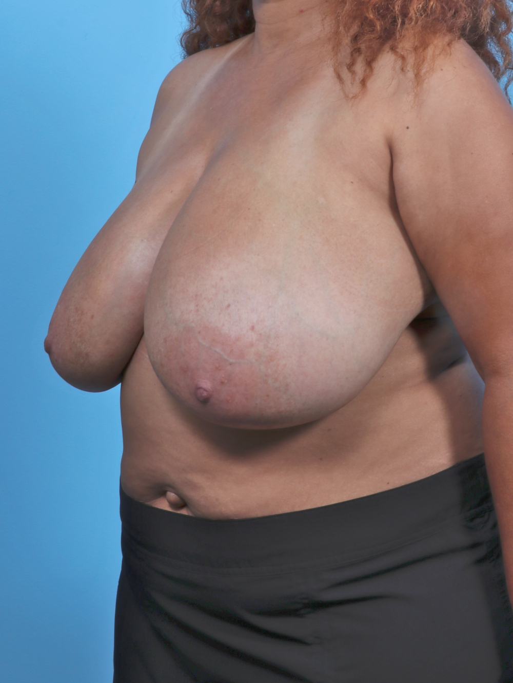 Breast Lift/Reduction Patient Photo - Case 4850 - before view-1