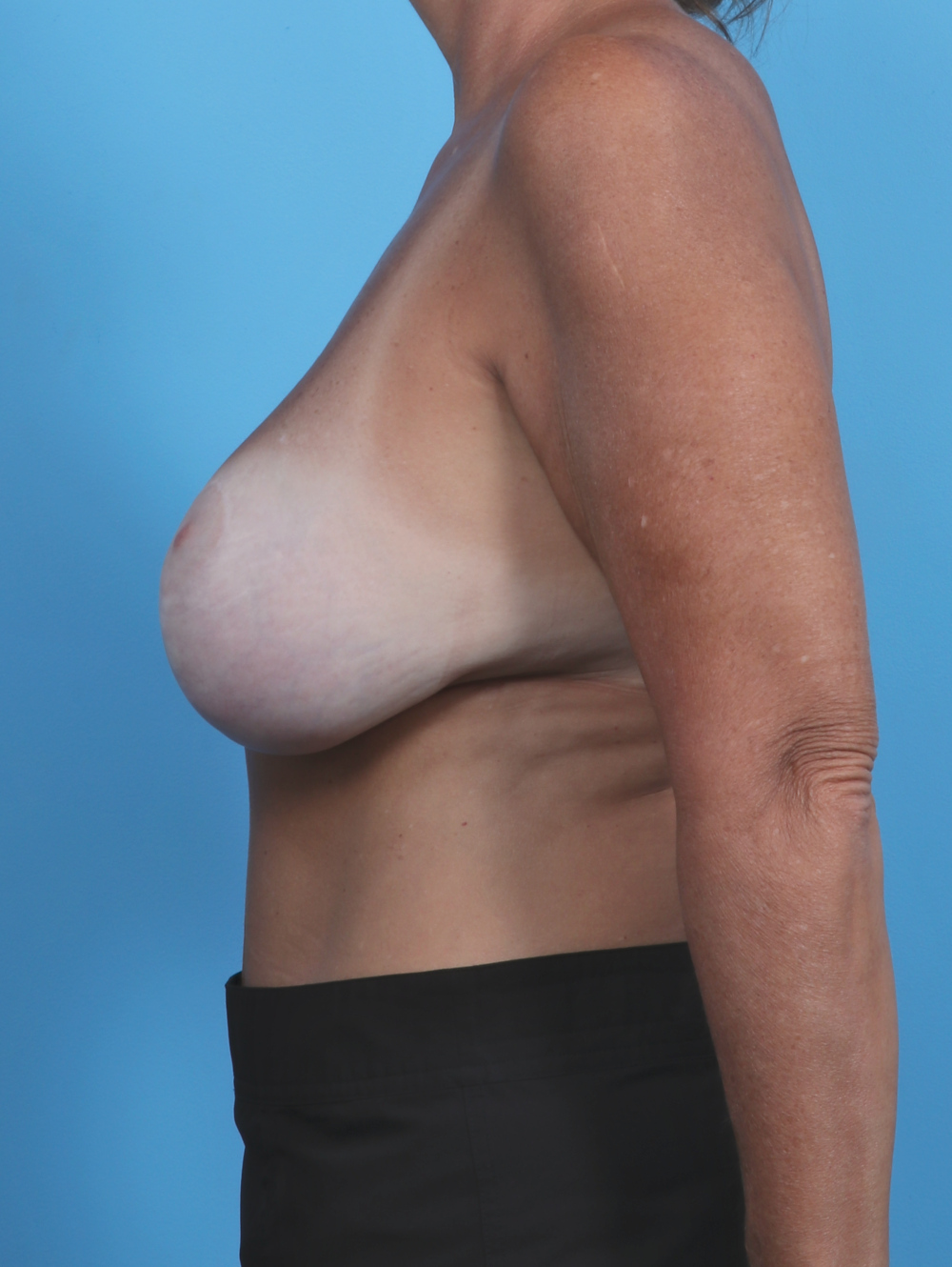 Breast Implant Revision Patient Photo - Case 4858 - before view-2