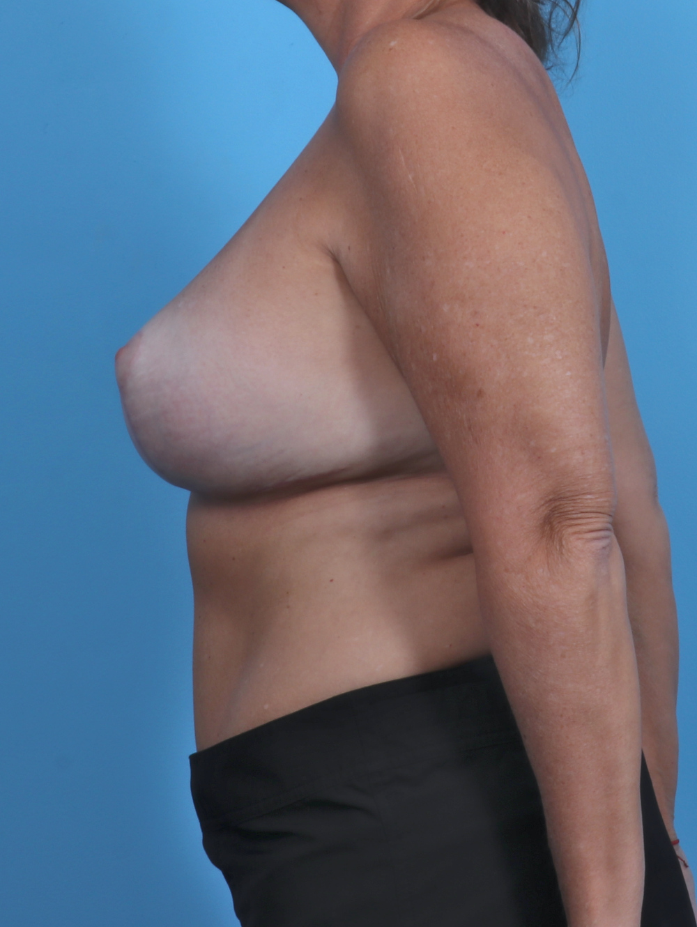 Breast Implant Revision Patient Photo - Case 4858 - after view-2